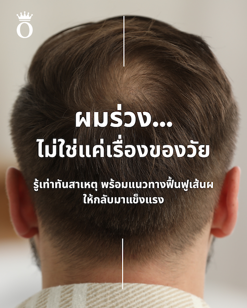 ผมร่วง…ไม่ใช่แค่เรื่องของวัย