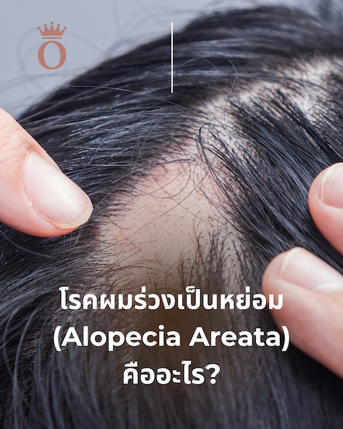 โรคผมร่วงเป็นหย่อม (Alopecia Areata) คืออะไร?